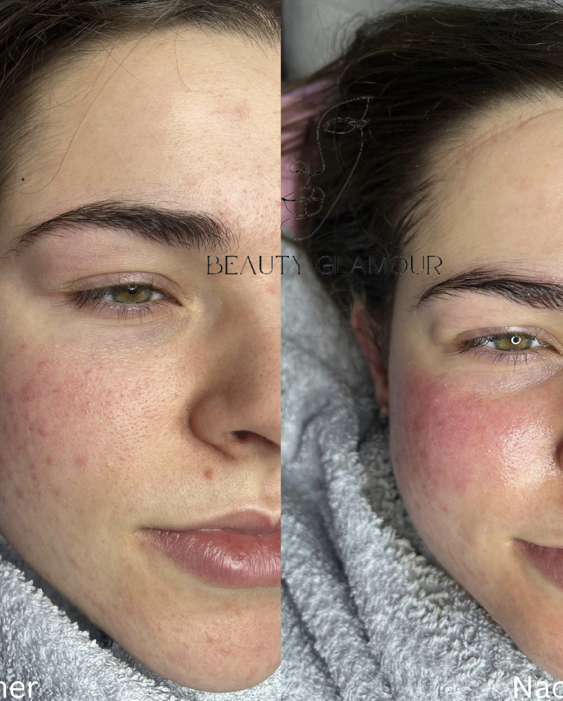 Beauty Glamour — Hautbild Vorher-Nachher